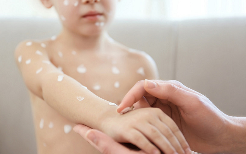 Proč je důležité očkování planých neštovic